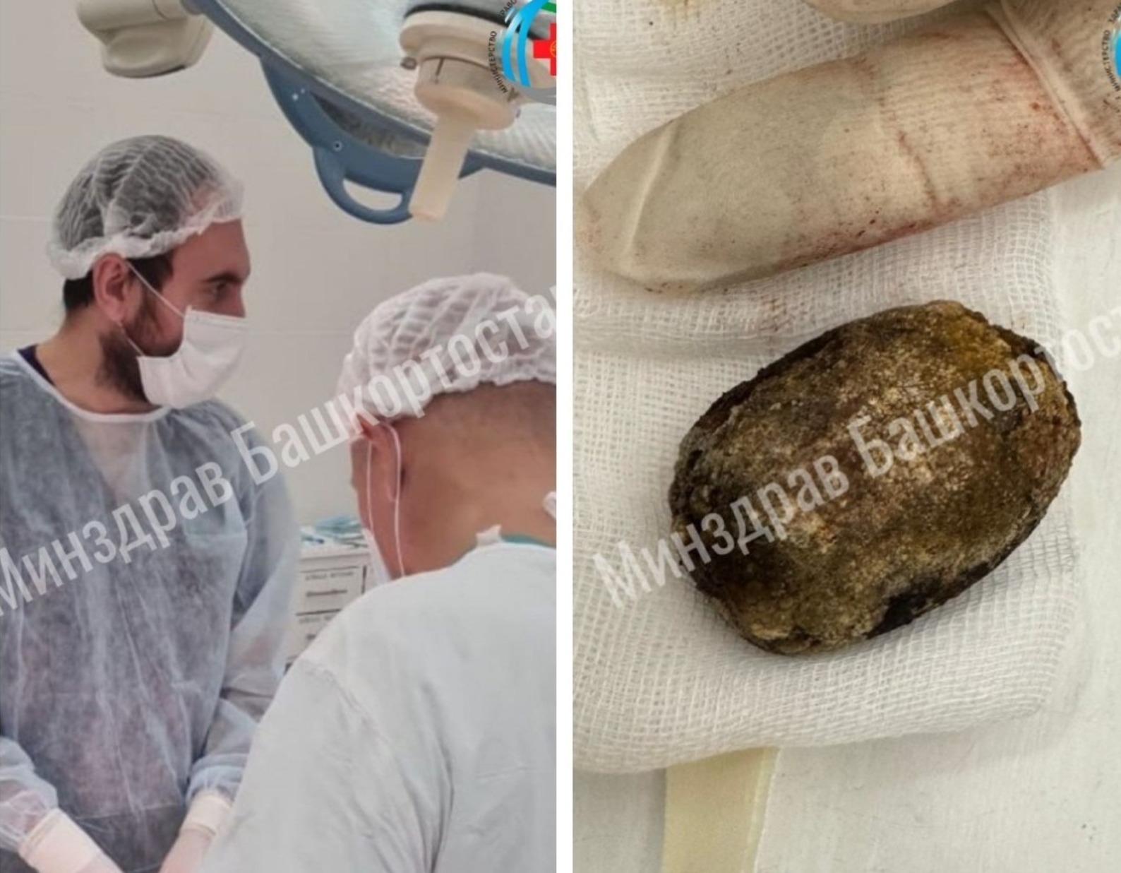 Врачи Башкирии удалили камень из желчного пузыря размером с куриное яйцо