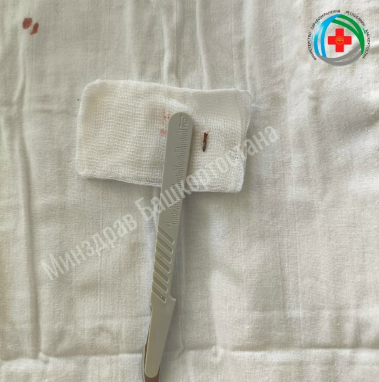 В Башкирии в шею женщины воткнулась деталь из триммера