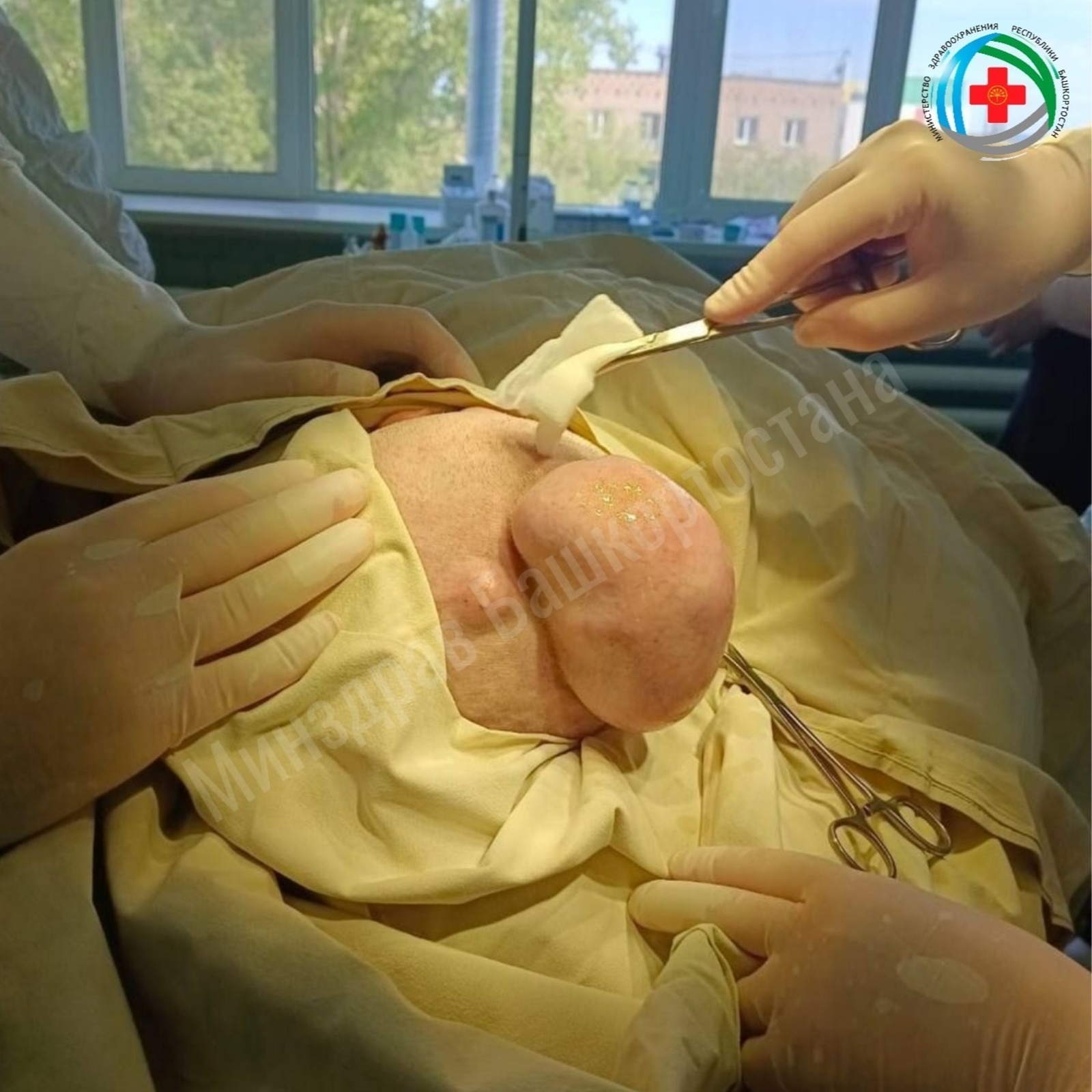 В Бирске прооперировали 77-летнюю женщину с гигантской кистой на голове